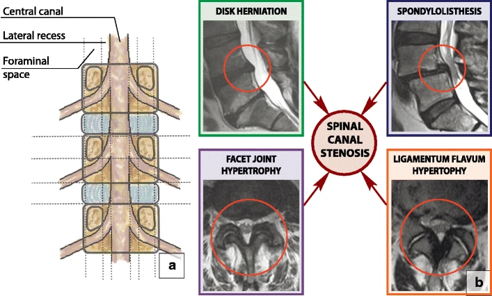 File:Spinal canal.webp