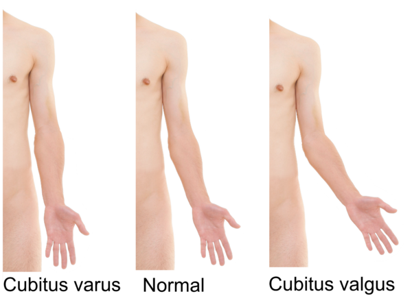 File:Cubitus varus and cubitus valgus.png