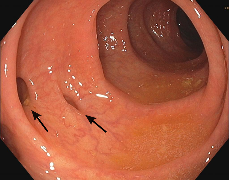 File:Diverticulosis (two diverticula) 01.svg