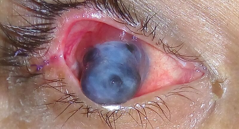 File:Anterior staphyloma.jpg