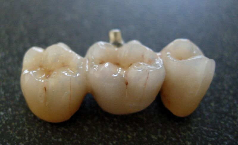 File:Bridge from dental porcelain.jpg