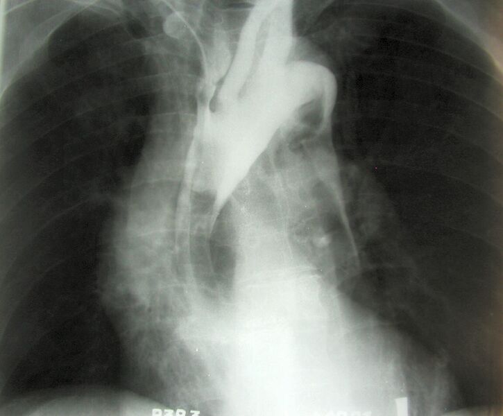 File:Dissecting aneurysm 01.jpg