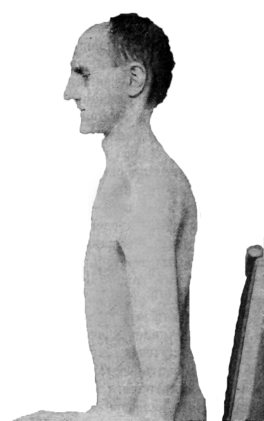 File:Asthenic Schizophrenic.png