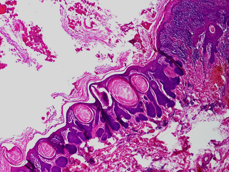 File:SkinTumors-P6190340.JPG
