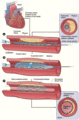 PTCA stent procedure
