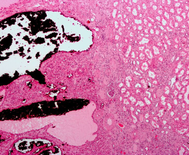 File:Renal oncocytoma4.jpg