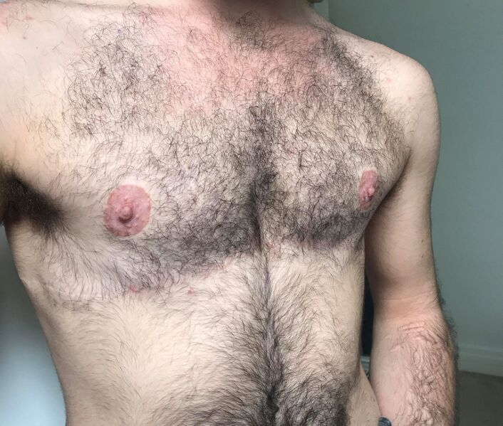 File:Double mastectomy.jpg