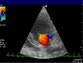 Doppler echocardiography of mitral valve
