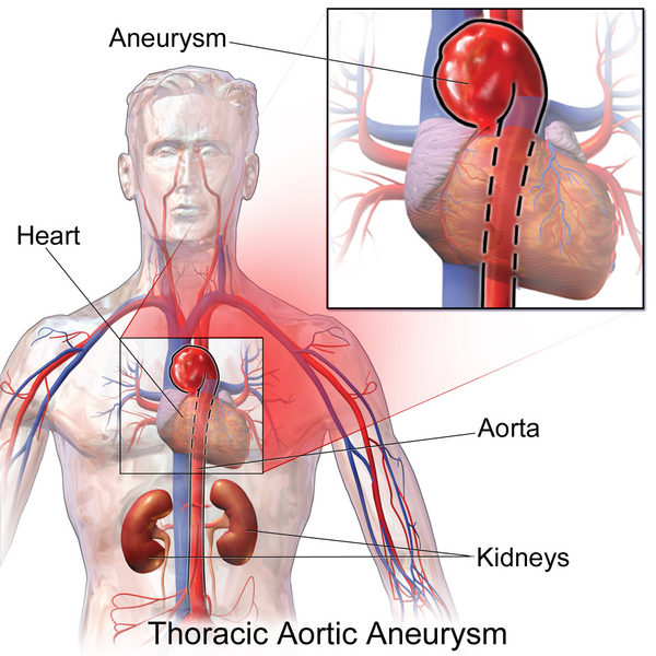 File:Thoracic Aortic Aneurysm.png