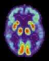 Alzheimer's brain PET scan