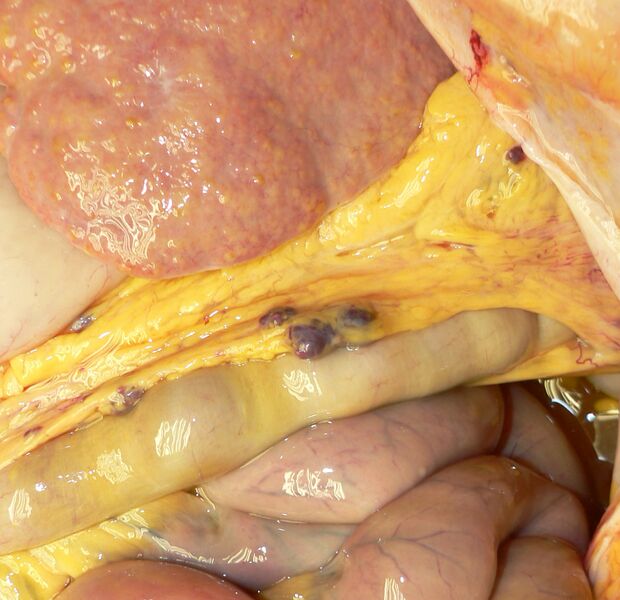File:Splenose.jpg