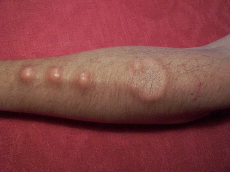 File:Bodymodificationimplantball.jpg