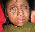 Xeroderma pigmentosum