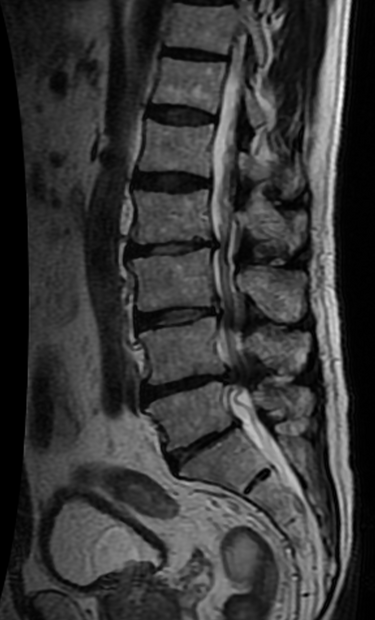 File:Lumbar spinal stenosis 1 8.png