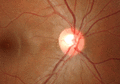 Optic_disc
