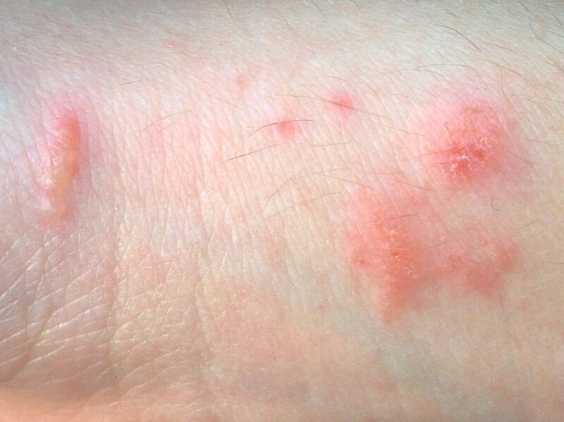 File:Poison ivy contact dermatitis.jpg