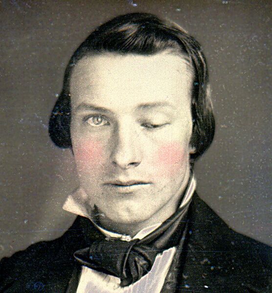 File:1852 ptosis patient.jpg