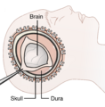 Cranial_drill