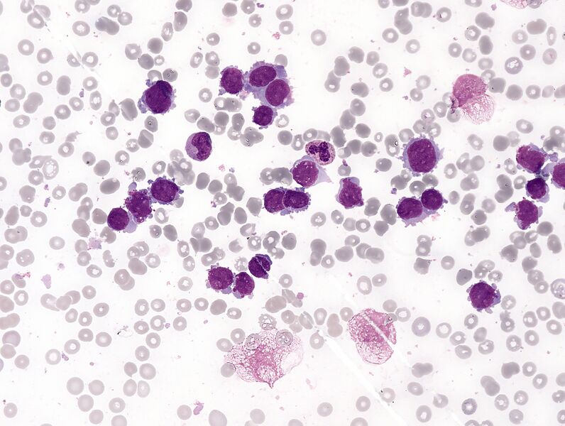File:Acute megakaryoblastic leukemia.jpg
