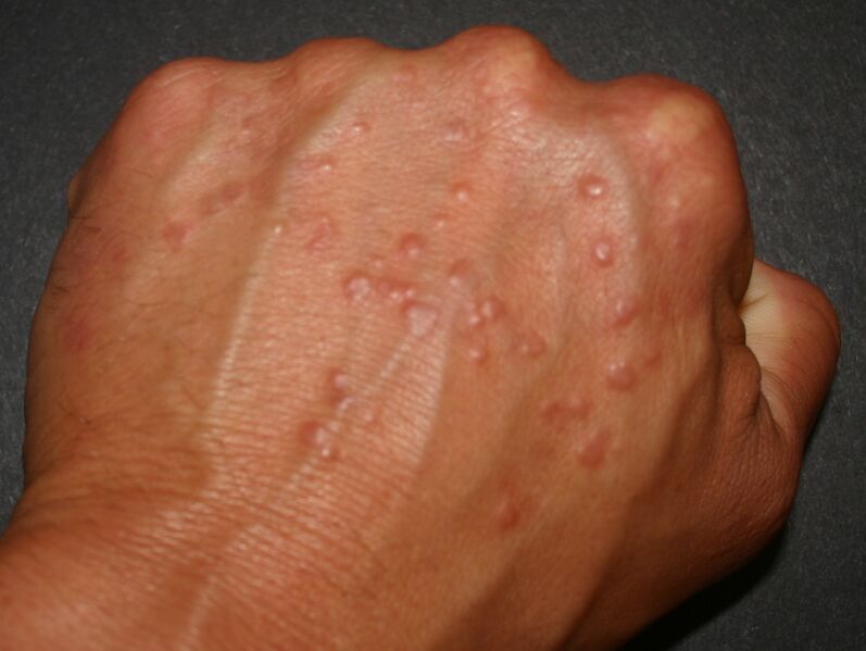 File:Granuloma annulare.jpg