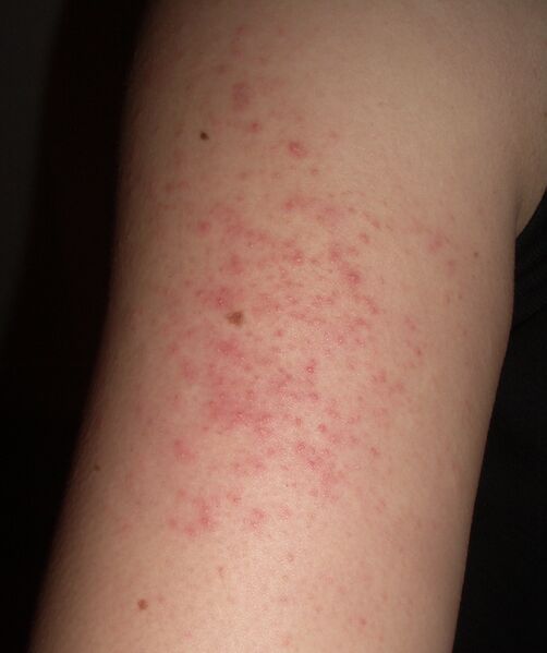 File:Keratosis pilaris arm.jpg