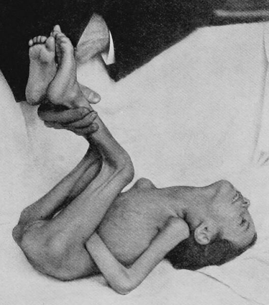 File:Kernig's sign cerebrospinal meningitis.jpg