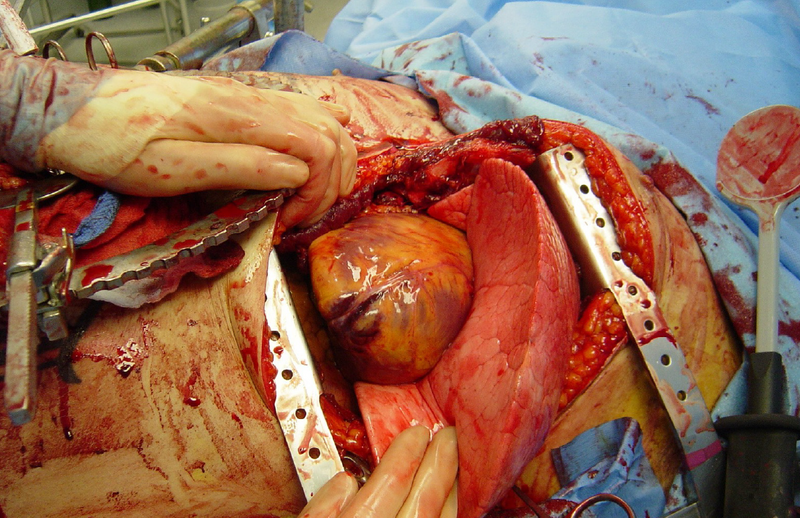 File:Emergency Thoracotomy.png