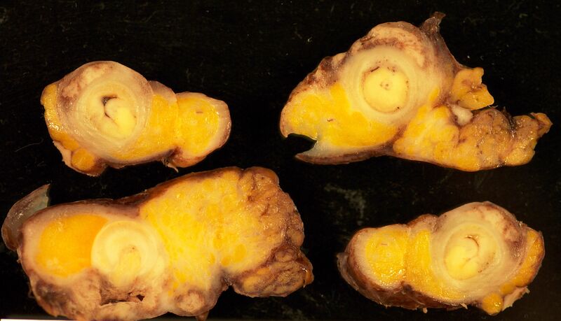 File:Appendiceal carcinoid 1.JPG