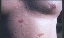 Early neurofibromatosis