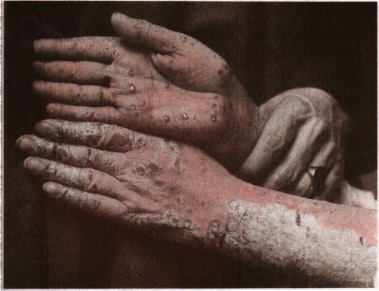 File:Psoriasis manum.jpg