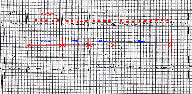 File:A-fib.png