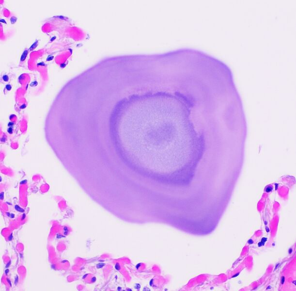 File:Histopathology of pulmonary alveolar microlithiasis.jpg