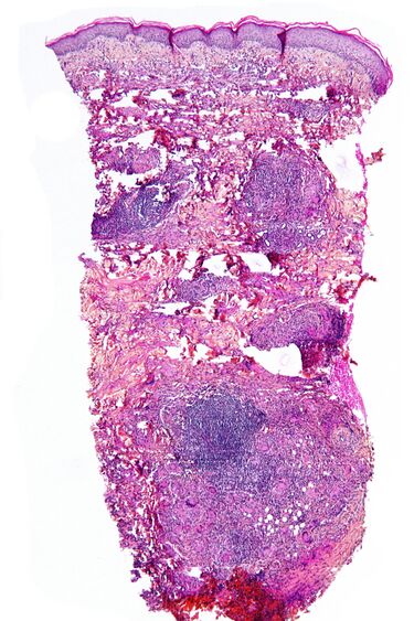 File:Necrobiosis lipoidica - low mag.jpg