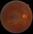 Digital retinography for retina and macula evaluation