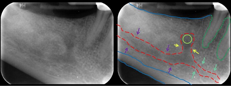 File:Mandibular Incisive Canal Highlighted.jpg