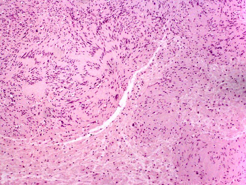 File:Skin Tumors-PA291039.jpg