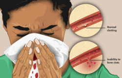 A woman suffering from Hemophilia