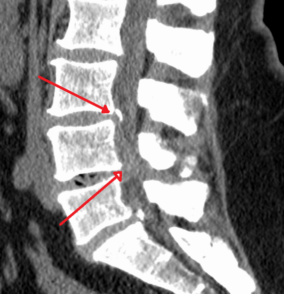 File:SpinalCanalStenosisL3445.png