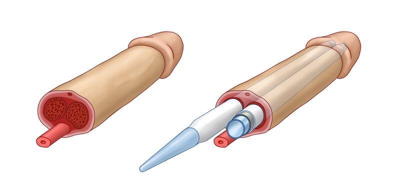 File:Inflatable penile implant.jpg