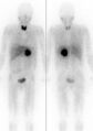 Scan showing Pheochromocytoma