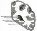 Collateral fissure