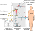 Hemodialysis process