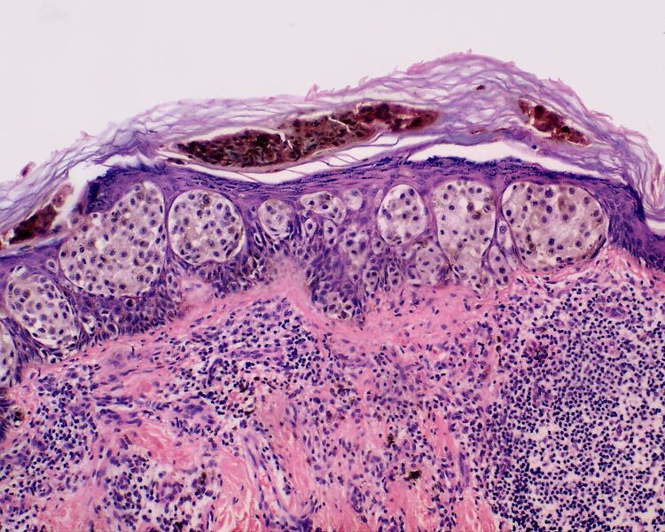 File:Skin Tumors-450.jpg