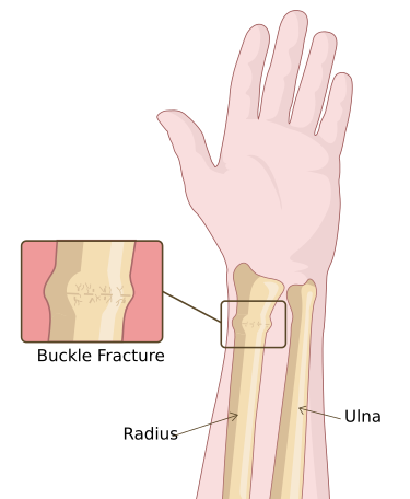 File:Buckle fracture of the Radius.svg