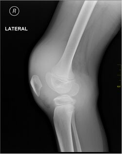 X-ray of knee hemarthrosis