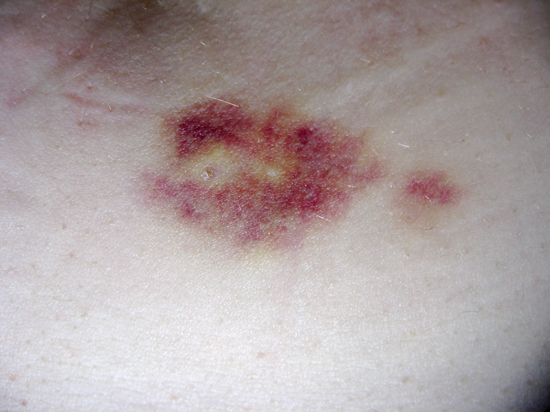 File:Implant.png