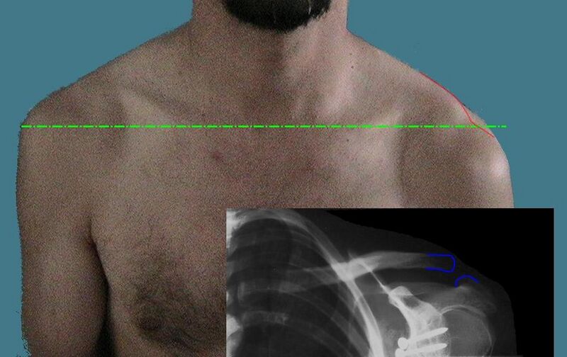 File:Luxation acromioclaviculaire.jpeg