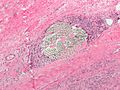 Suture material under microscope