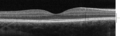 Retina