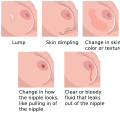 Invasive carcinoma of no special type